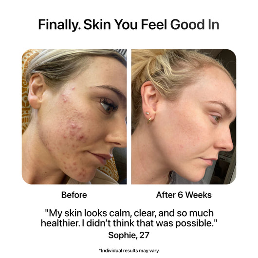 Before And After Girl Using The Ion Pro Review 